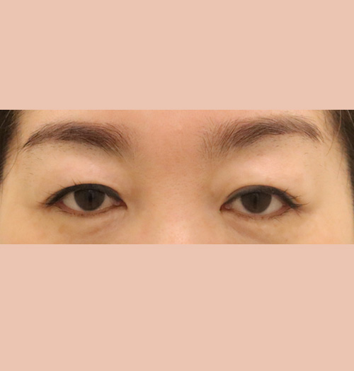 치료 전 이미지