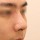 치료 후 이미지